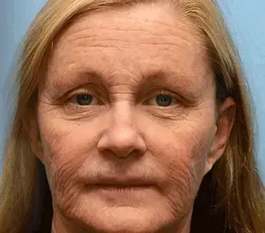 Botox Bee Venom Wrinkle - Image 15