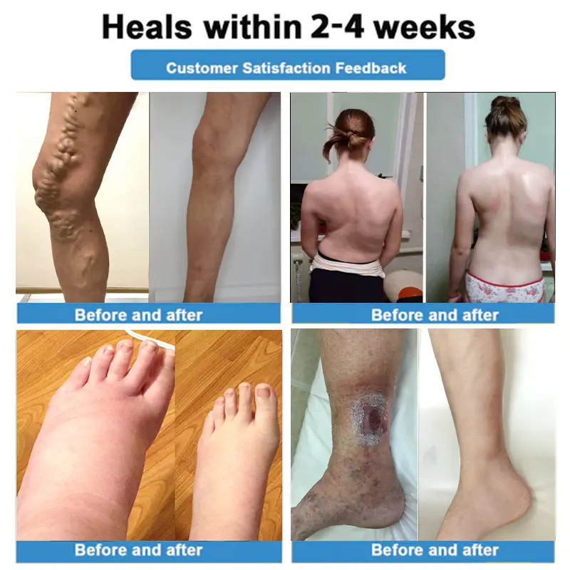 🛒4-in-1 Vein & Joint Nano Microneedle Advanced Therapy Patch🔥 - Image 3