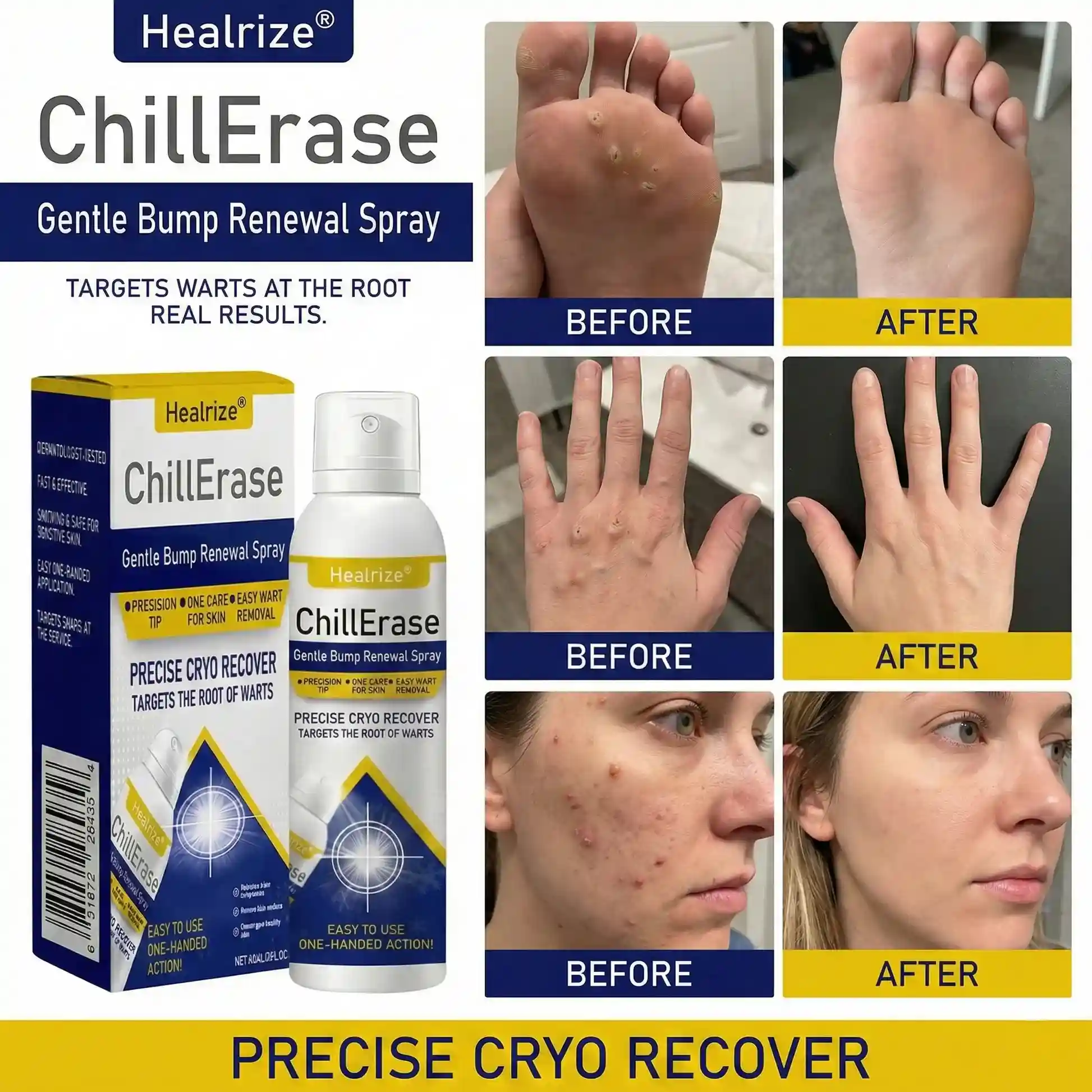 ChillErase Gentle Bump Renewal Spray✨ — Pain-Free, Acid-Free Gentle Wart Removal - Image 3