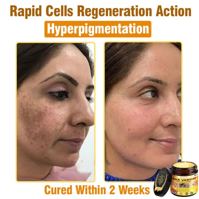 𝐁𝐞𝐞 𝐕𝐞𝐧𝐨𝐦 𝐀𝐥𝐥-𝐢𝐧-𝐎𝐧𝐞 𝐂𝐫𝐞𝐚𝐦–🌸 Anti-aging,Hydrating, Skin Repair, Even Tone, Acne and Dark Spot Treatment, Wart and Mole Removal, Psoriasis Relief - Image 10