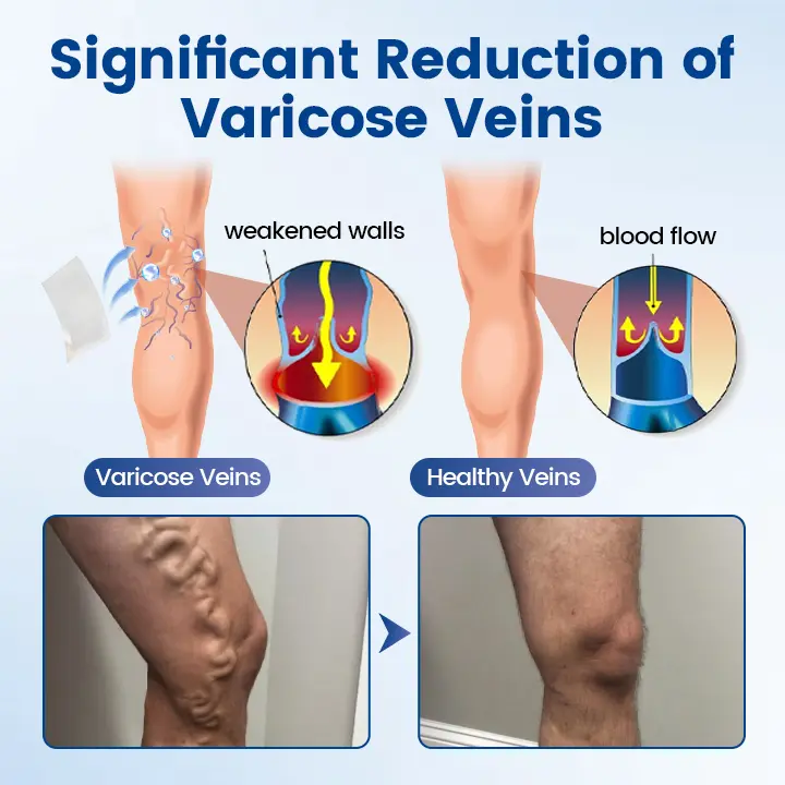 Vein Ease Microneedle Therapy Patch - Image 5