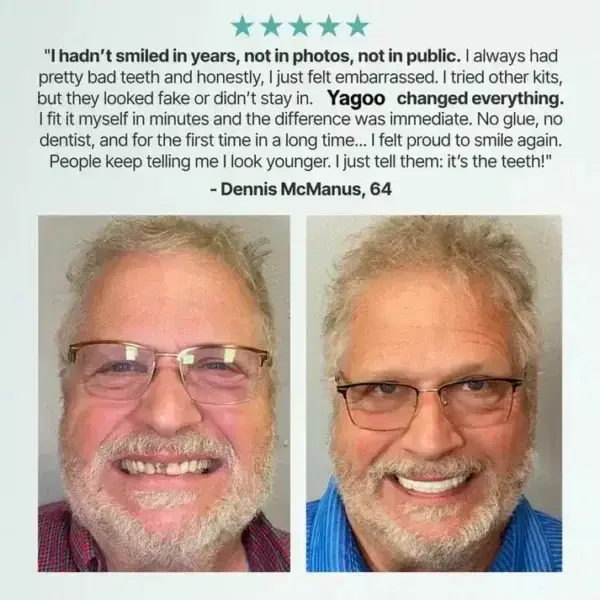 Medical Full Denture with Strong Suctiond - Image 20