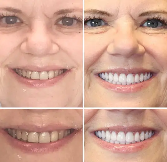 Made in Germany Advanced Customized Full Denture Set - Image 8