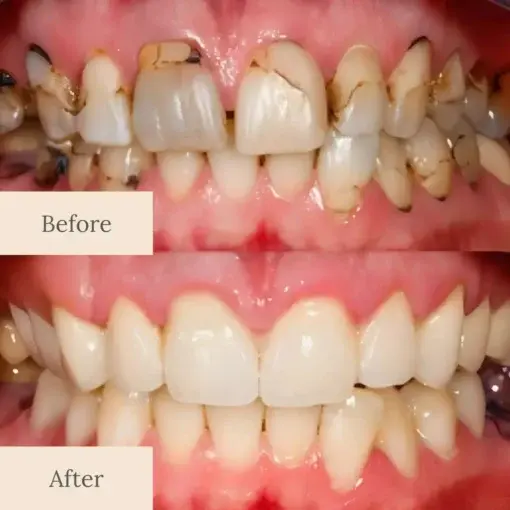 Advanced Enamel Repair & Whitening Kit - Image 7