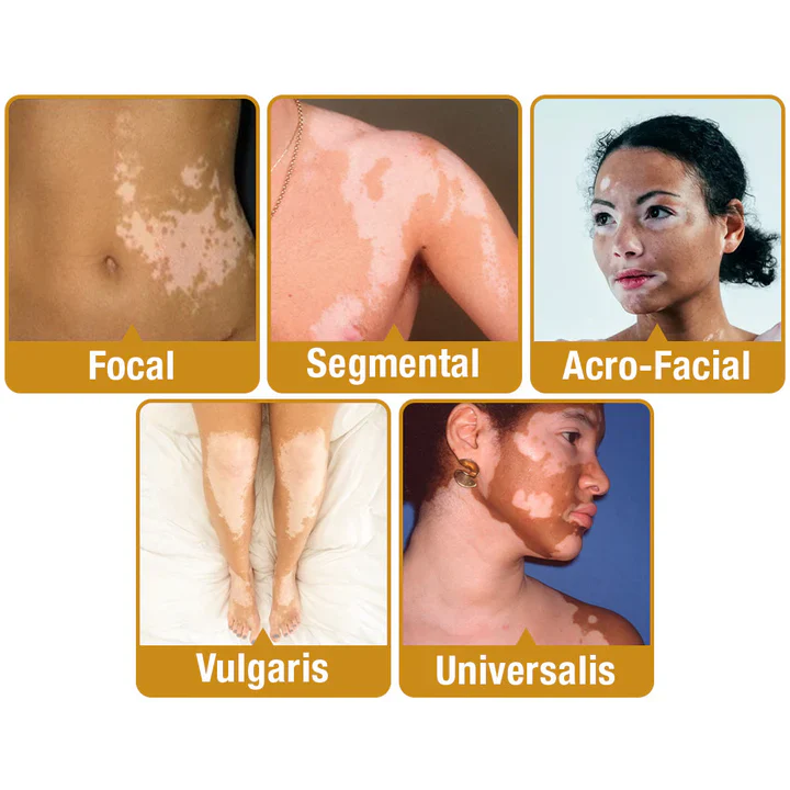 BeeVenom Vitiligo Treatment Cream - Image 4