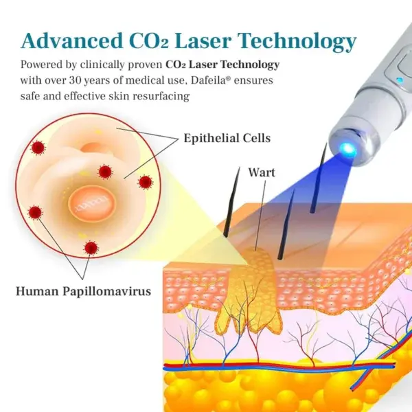 LumeSkin Mole and Wart Removal Laser Pen - Image 7