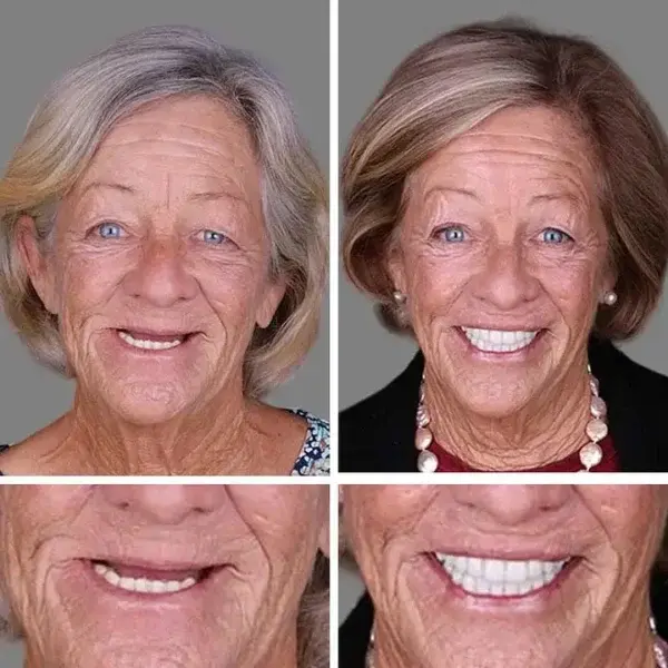 Premium Denture 2026 | Custom-Fit Dentures - Image 10