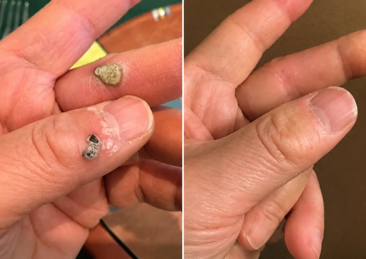 2-in-1 Microneedle & Hydrocolloid Patch - Image 7