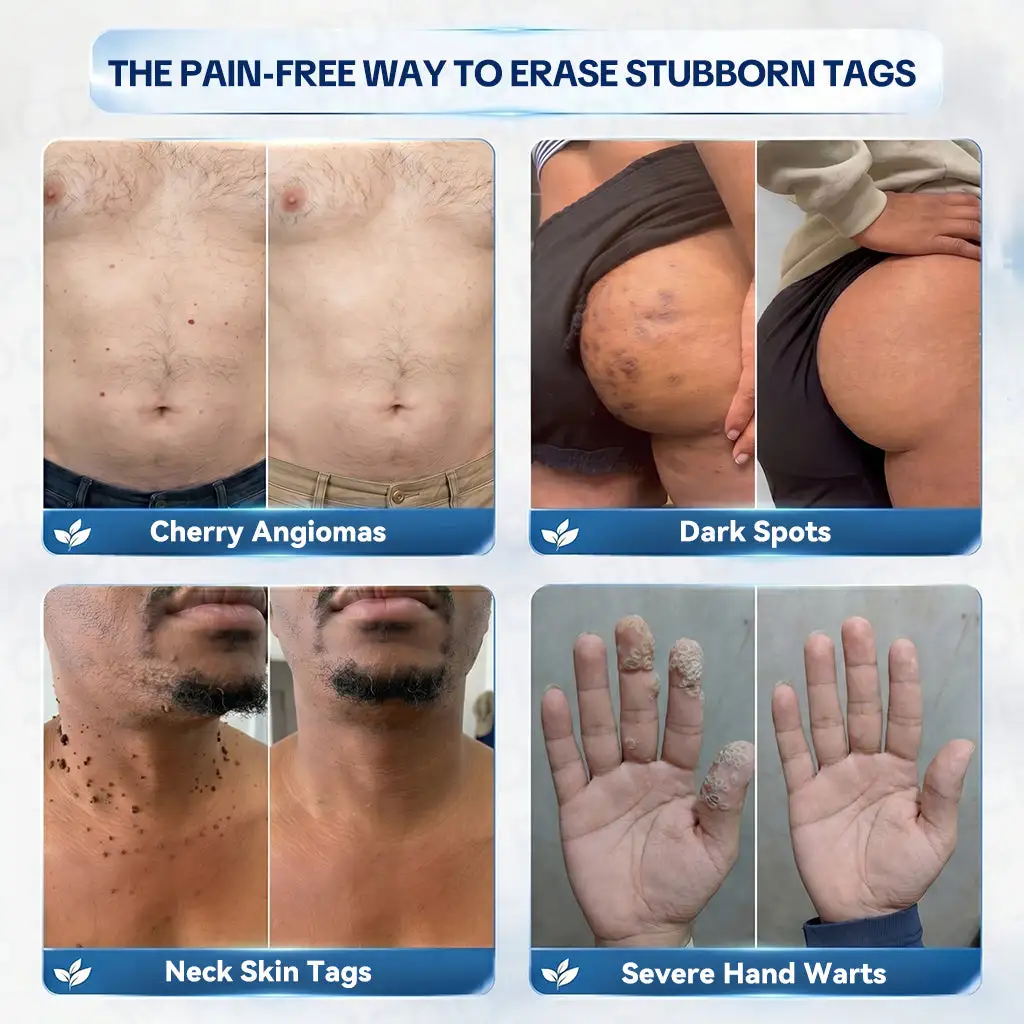 7-𝐃𝐚𝐲 𝐒𝐤𝐢𝐧 𝐓𝐚𝐠 & 𝐒𝐩𝐨𝐭 𝐄𝐫𝐚𝐬𝐞𝐫 𝐂𝐫𝐞𝐚𝐦 - Image 3