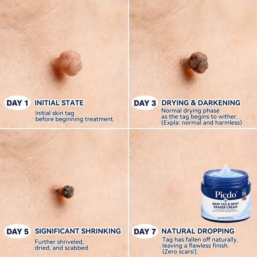 7-𝐃𝐚𝐲 𝐒𝐤𝐢𝐧 𝐓𝐚𝐠 & 𝐒𝐩𝐨𝐭 𝐄𝐫𝐚𝐬𝐞𝐫 𝐂𝐫𝐞𝐚𝐦 - Image 4