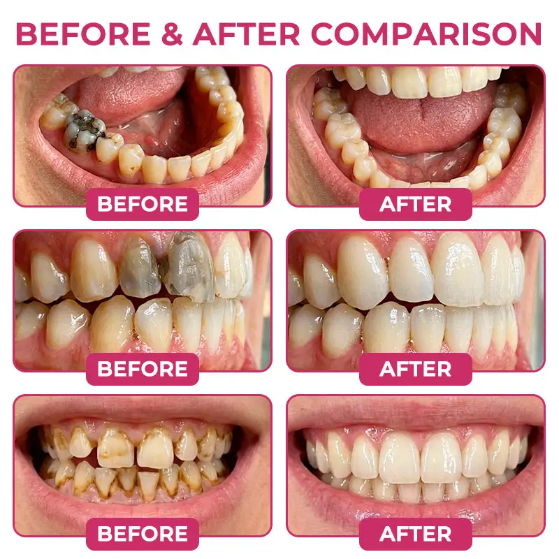 DenPerm Cavity-Repair Natural Enamel Filling Gel - Image 2