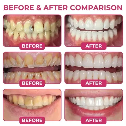 KLENIMORE DenPerm Cavity-Repair Natural Enamel Filling Gel - Image 3
