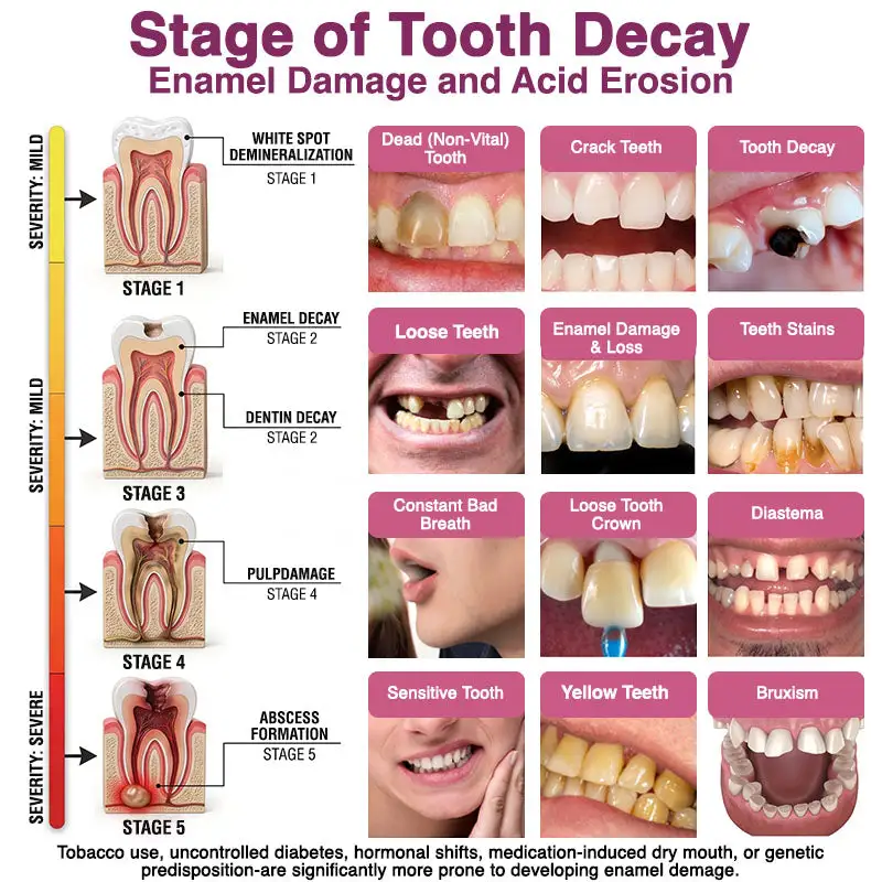 DenPerm Cavity-Repair Natural Enamel - Image 6